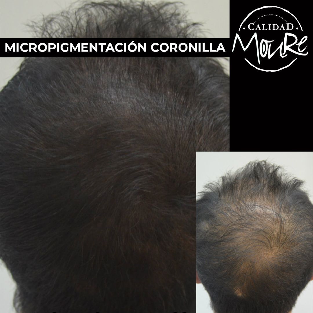 Micropigmentación capilar hombre relleno pelo largo (5)