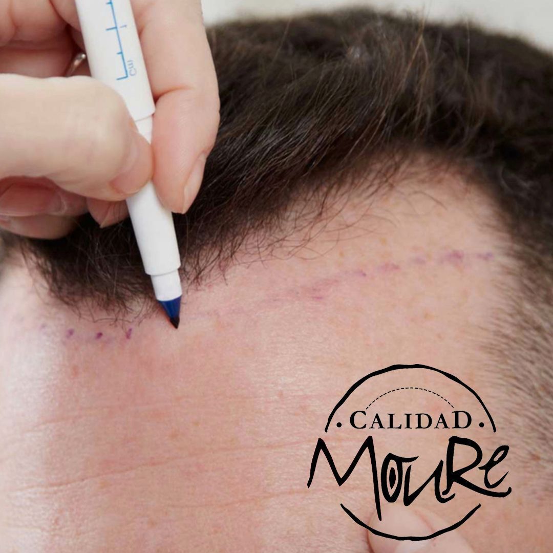 Micropigmentación capilar hombre relleno pelo largo (6)