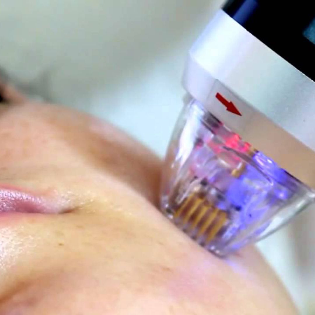 APARATOLOGIA RADIOFRECUENCIA CENTROS MOURE MALLORCA (10)