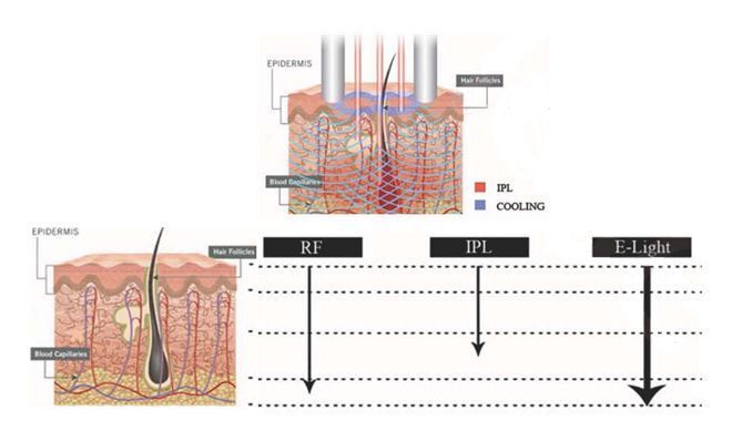 DEPILACION LASER MALLORCA (17)