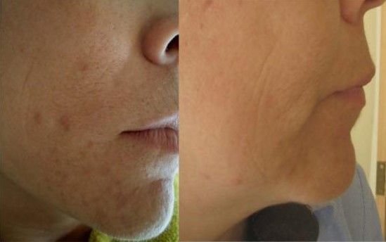 DEPILACION LASER MALLORCA (18)