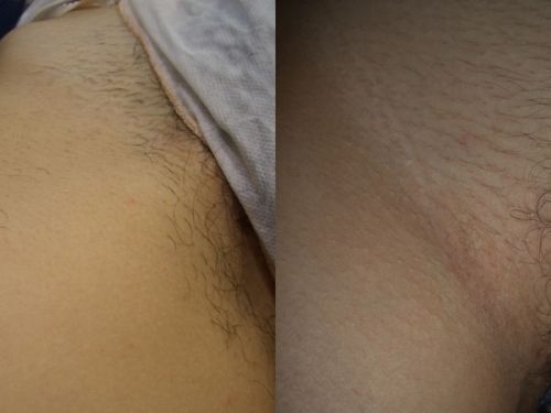 DEPILACION LASER MALLORCA (3)