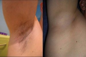 DEPILACION LASER MALLORCA (4)