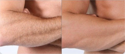 DEPILACION LASER MALLORCA (6)