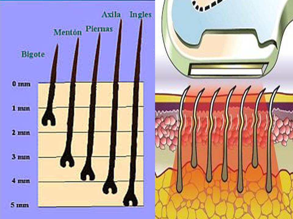DEPILACION LASER MALLORCA (9)