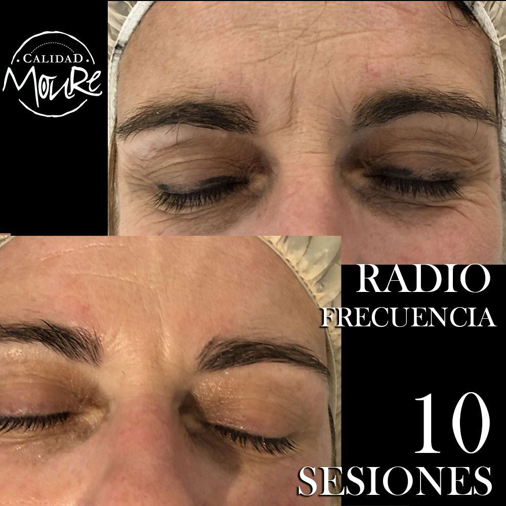 RADIOFRECUENCIA LASER GALVANICA Y ACIDO HIALURONICO CENTRO DE ESTETICA MOURE MALLORCA (1)