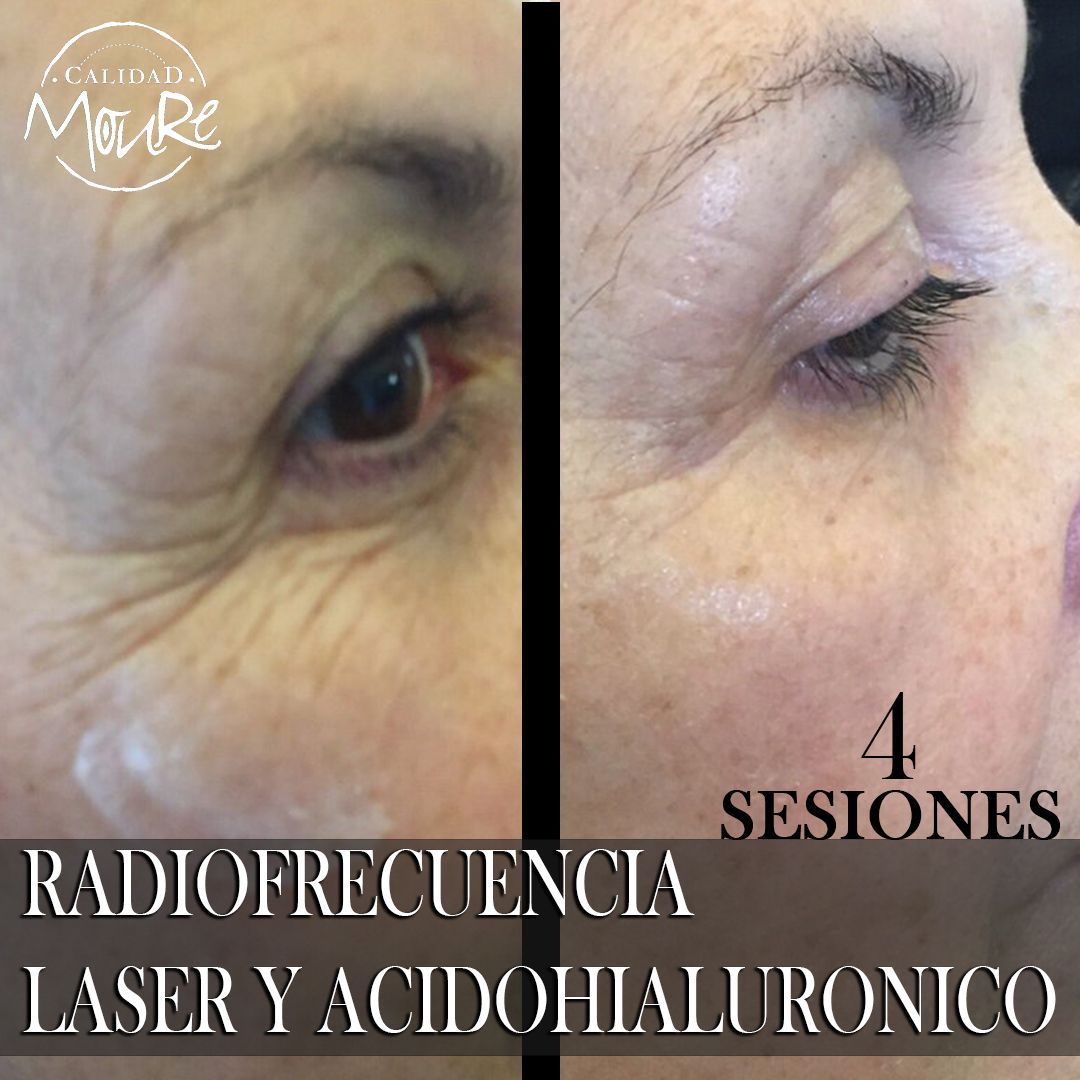 RADIOFRECUENCIA LASER GALVANICA Y ACIDO HIALURONICO CENTRO DE ESTETICA MOURE MALLORCA (2)