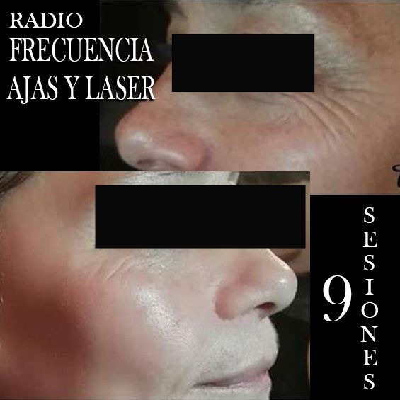 RADIOFRECUENCIA LASER GALVANICA Y ACIDO HIALURONICO CENTRO DE ESTETICA MOURE MALLORCA (4)