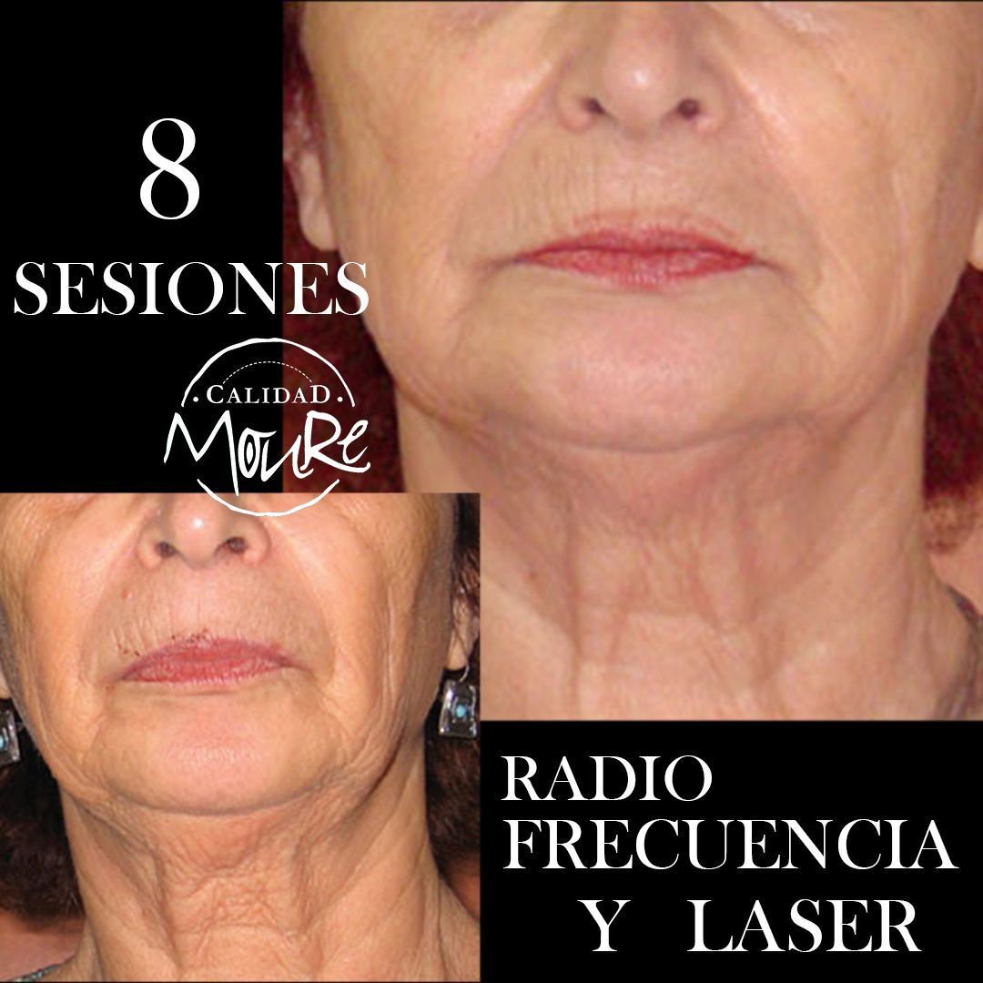 RADIOFRECUENCIA LASER GALVANICA Y ACIDO HIALURONICO CENTRO DE ESTETICA MOURE MALLORCA (6)
