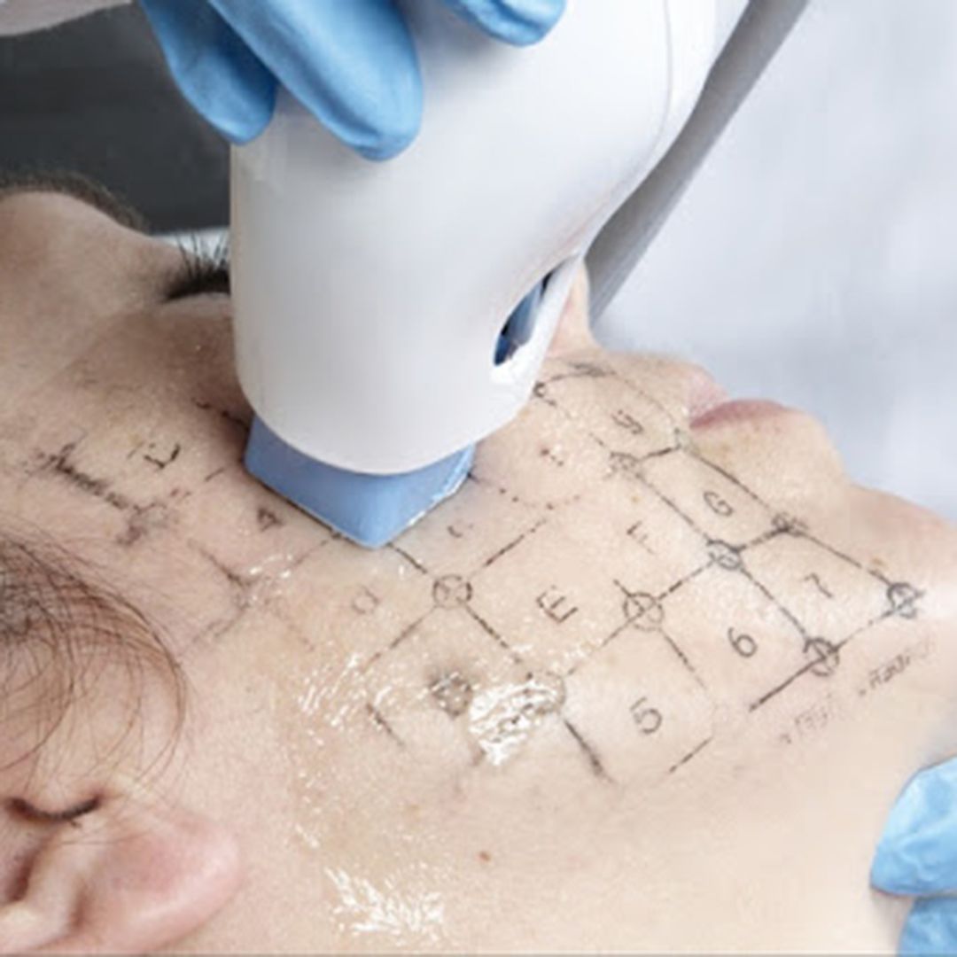 RADIOFRECUENCIA LASER GALVANICA Y ACIDO HIALURONICO CENTRO DE ESTETICA MOURE MALLORCA (9)