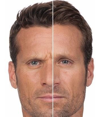 TRATAMIENTO FACIAL HOMBRE ANTES Y DESPUES BARBERIA PELUQUERIA MALLORCA MOURE (1)