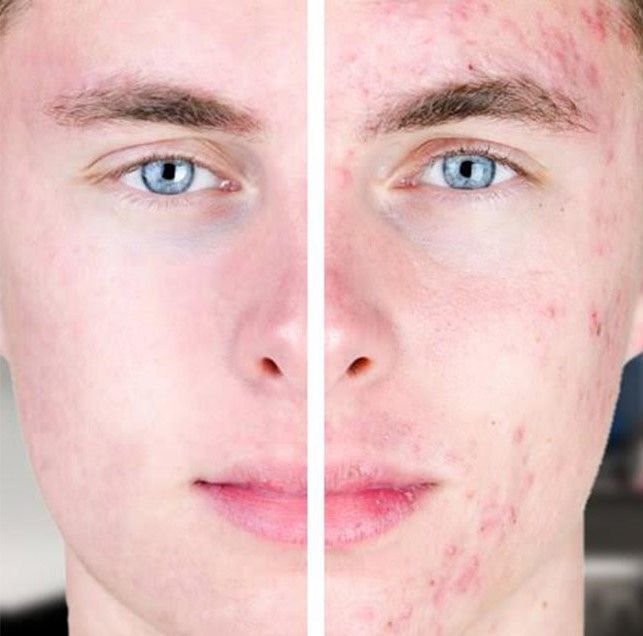 TRATAMIENTO FACIAL HOMBRE ANTES Y DESPUES BARBERIA PELUQUERIA MALLORCA MOURE (5)