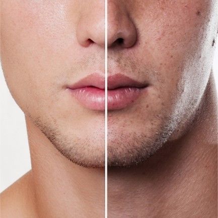 TRATAMIENTO FACIAL HOMBRE ANTES Y DESPUES BARBERIA PELUQUERIA MALLORCA MOURE (6)