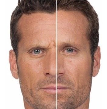 TRATAMIENTO FACIAL HOMBRE ANTES Y DESPUES BARBERIA PELUQUERIA MALLORCA MOURE (7)