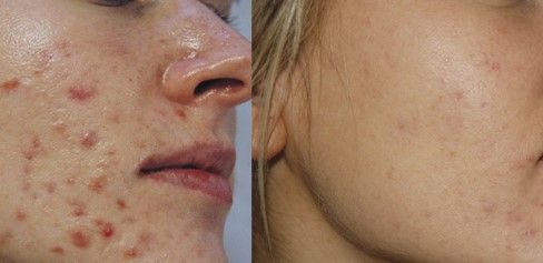 ACNE EN LA CARA ANTES Y DESPUES (18)