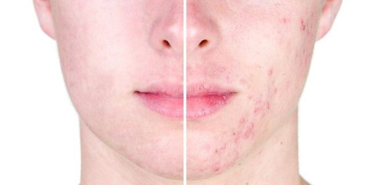 ACNE EN LA CARA ANTES Y DESPUES (4)