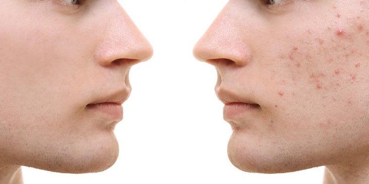 ACNE EN LA CARA ANTES Y DESPUES (7)