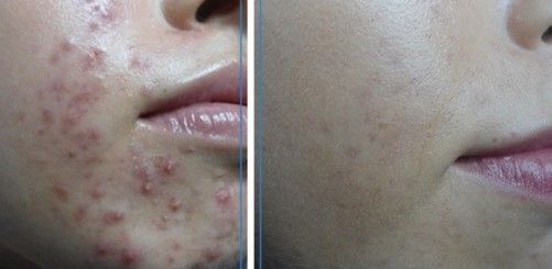 ACNE EN LA CARA ANTES Y DESPUES (8)