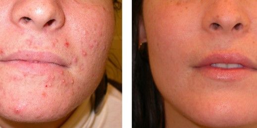 ACNE EN LA CARA ANTES Y DESPUES CENTROS MOURE MALLORCA (19)