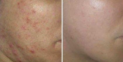 ACNE EN LA CARA ANTES Y DESPUES CENTROS MOURE MALLORCA (2)