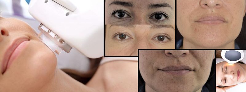 FOTOREJUVENECIMIENTO MALLORCA CENTRO DE ESTÉTICA MOURE