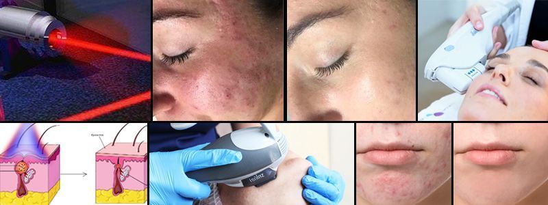 banner fotodepilacion