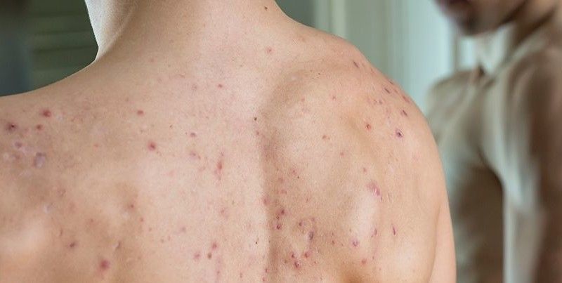 TRATAMIENTO DE ACNE EN LA ESPALDA MALLORCA CENTROS MOURE (13)