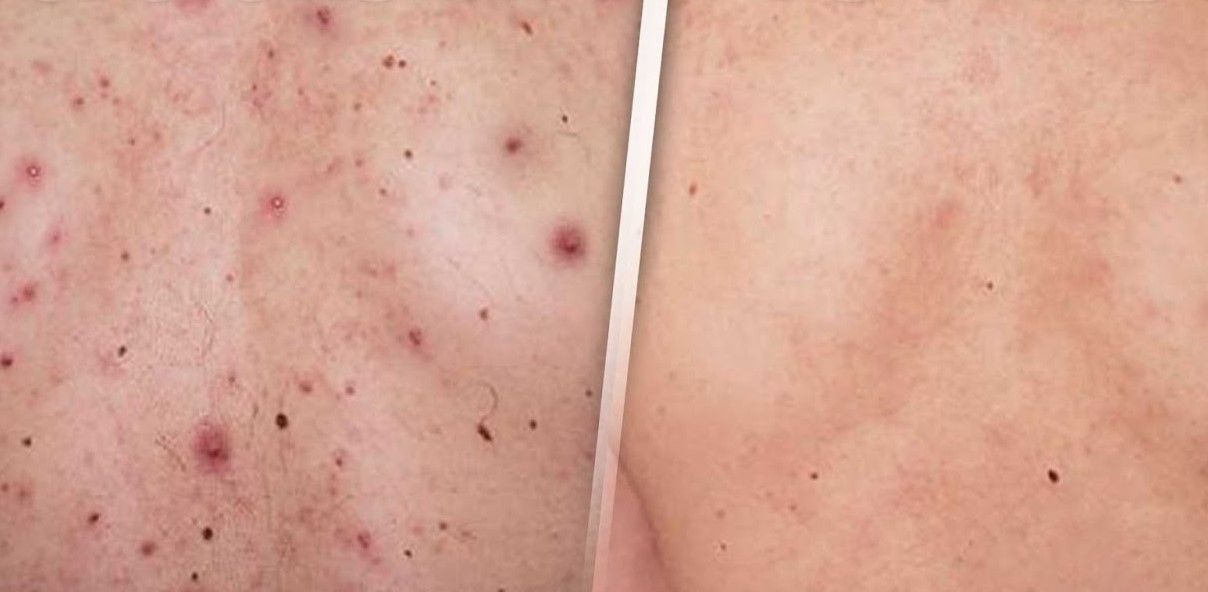 TRATAMIENTO DE ACNE EN LA ESPALDA MALLORCA CENTROS MOURE (17)