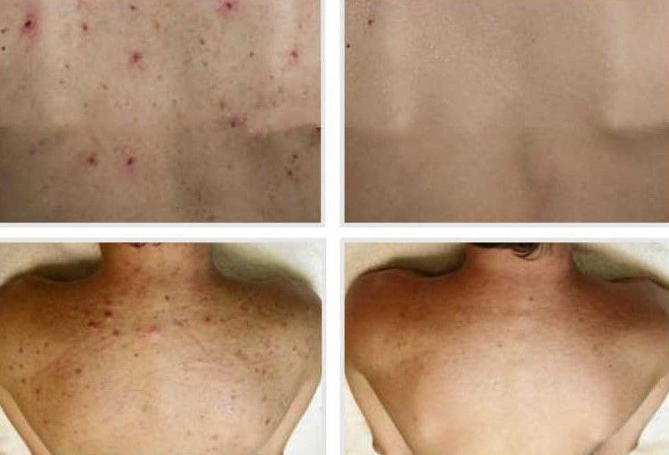 TRATAMIENTO DE ACNE EN LA ESPALDA MALLORCA CENTROS MOURE (3)