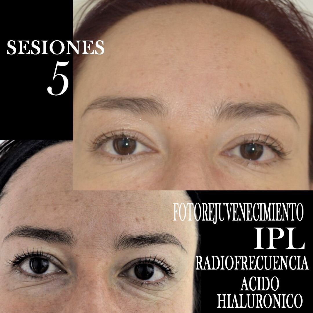 TRATAMIENTO FOTOREJUVENECIMIENTO FACIAL CENTROS