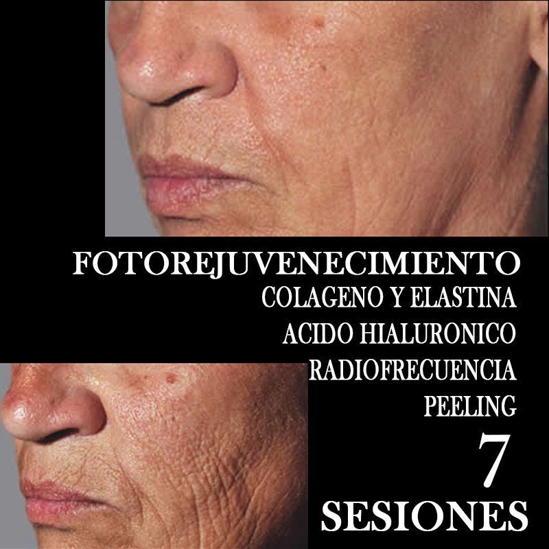 TRATAMIENTO FOTOREJUVENECIMIENTO FACIAL CENTROS MOURE MALLORCA (2)