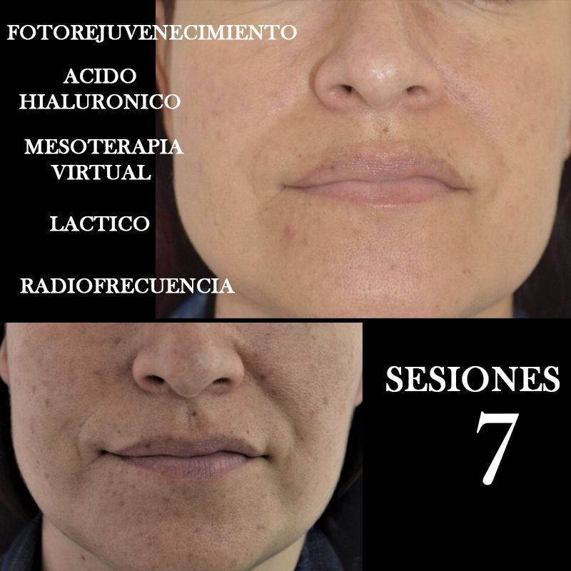 TRATAMIENTO FOTOREJUVENECIMIENTO FACIAL CENTROS MOURE MALLORCA (7)