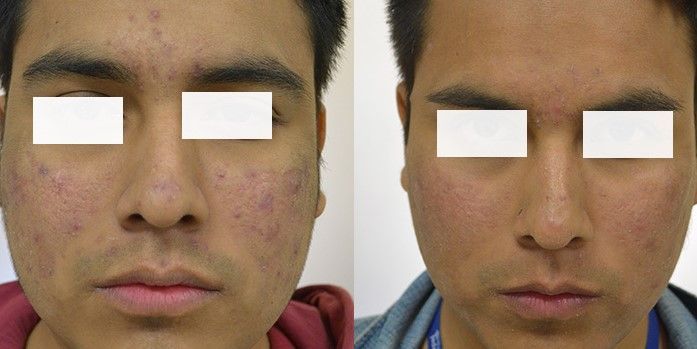 TRATAMIENTO PARA QUITAR MARCAS DE ACNE (5)