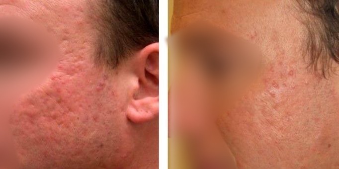 TRATAMIENTO PARA QUITAR MARCAS DE ACNE (6)