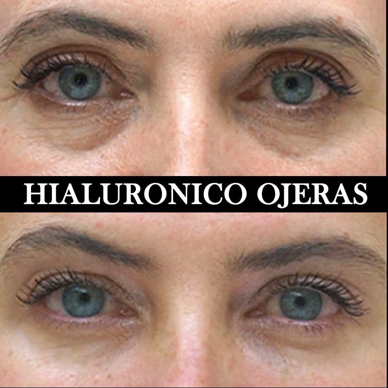 ACIDO HIALURONICO ENTRECEJO NASOJENIANO, OJOS CENTROS MOURE MALLORCA (1)