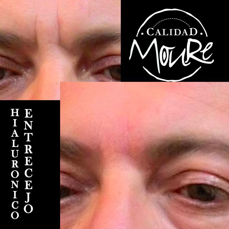 ACIDO HIALURONICO ENTRECEJO NASOJENIANO, OJOS CENTROS MOURE MALLORCA (10)