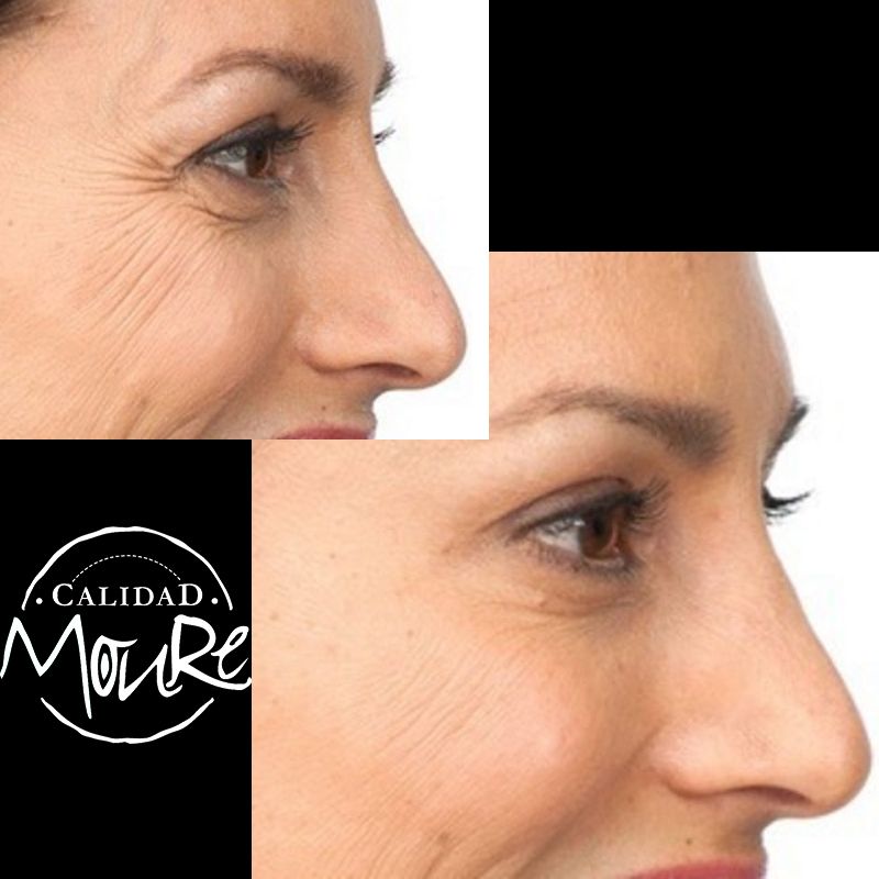 ACIDO HIALURONICO ENTRECEJO NASOJENIANO, OJOS CENTROS MOURE MALLORCA