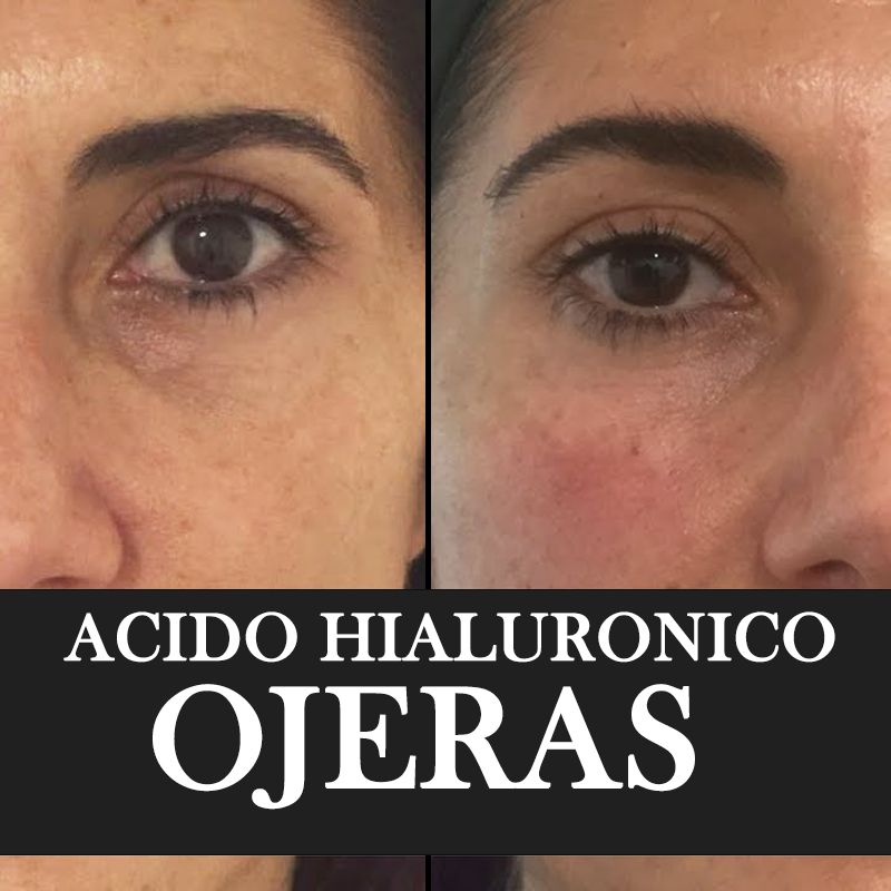 ACIDO HIALURONICO ENTRECEJO NASOJENIANO, OJOS CENTROS MOURE MALLORCA (9)