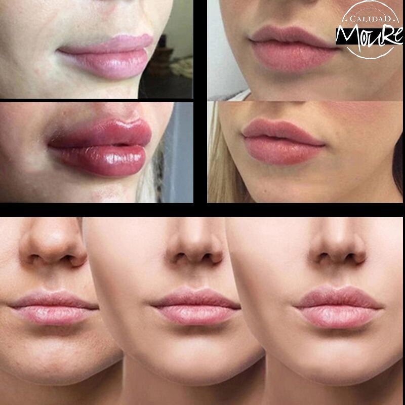 ACIDO HIALURONICO, HIALUROPEN, CENTRO DE ESTETICA MOURE MALLORCA, RELLENO (10)