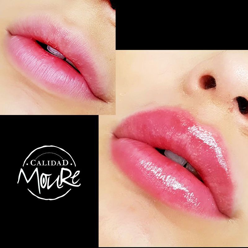 ACIDO HIALURONICO, HIALUROPEN, CENTRO DE ESTETICA MOURE MALLORCA, RELLENO (13)