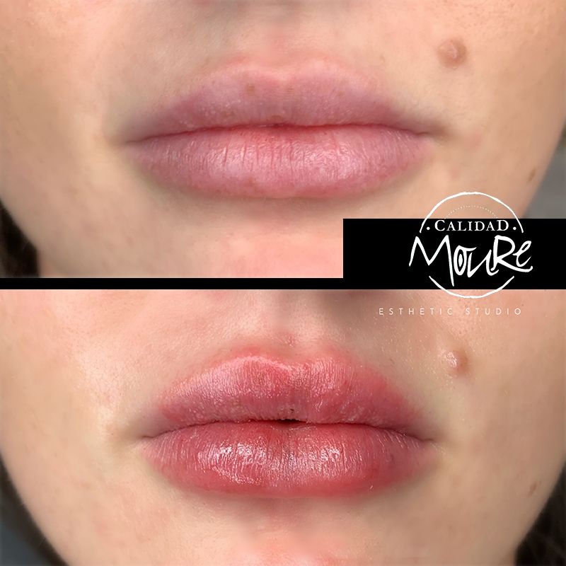 ACIDO HIALURONICO, HIALUROPEN, CENTRO DE ESTETICA MOURE MALLORCA, RELLENO (5)