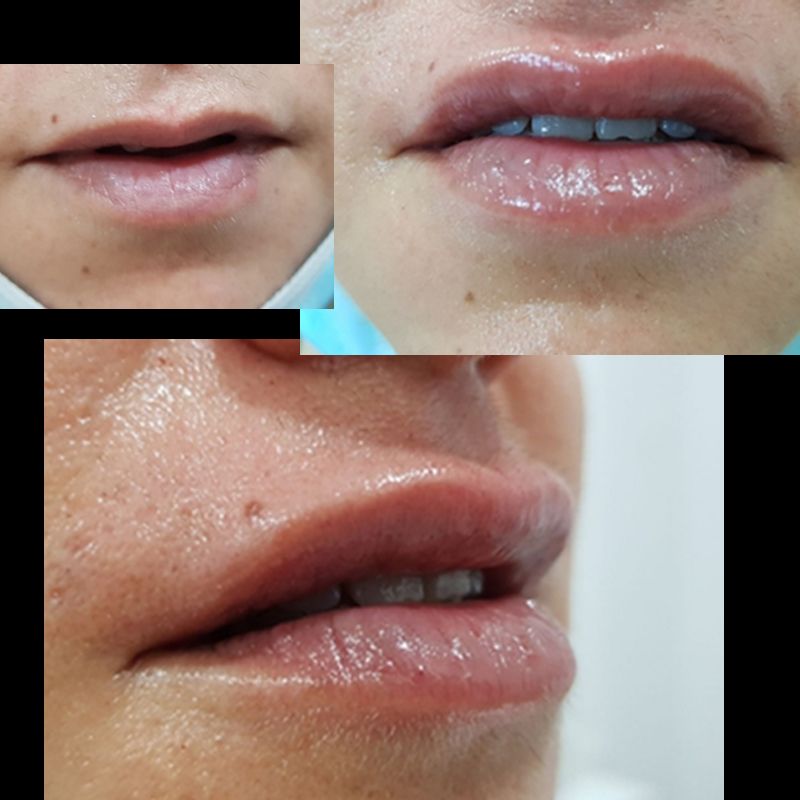 ACIDO HIALURONICO, HIALUROPEN, CENTRO DE ESTETICA MOURE MALLORCA, RELLENO (6)