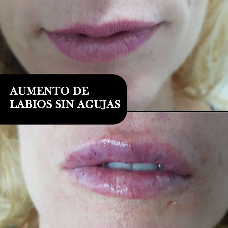 ACIDO HIALURONICO, HIALUROPEN, CENTRO DE ESTETICA MOURE MALLORCA, RELLENO (7)