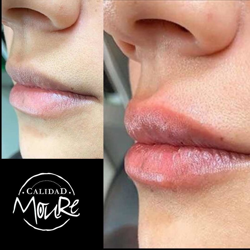 ACIDO HIALURONICO, HIALUROPEN, CENTRO DE ESTETICA MOURE MALLORCA, RELLENO (9)