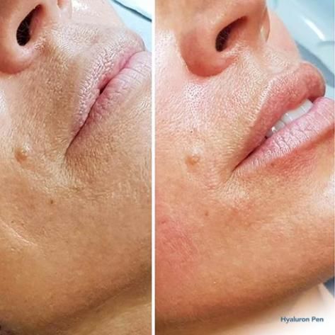 ACIDO HIALURONICO LABIOS, HIALUROPEN PALMA DE MALLORCA CENTROS MOURE (12)