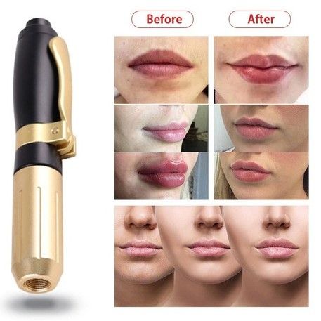 ACIDO HIALURONICO LABIOS, HIALUROPEN PALMA DE MALLORCA CENTROS MOURE (7)