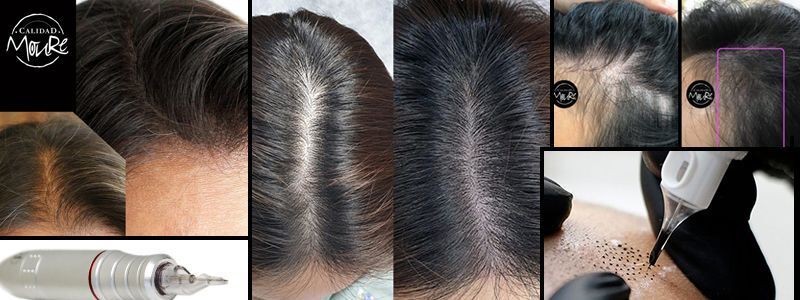 BANNER MICROPIGMENTACION CAPILAR MUJER PALMA DE MALLORCA CENTROS MOURE