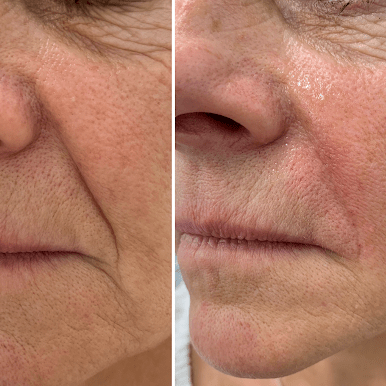 HIALUROPEN , HACIDO HIALURONICO ,ENTRECEJO Y NASOGENIANO,MALLORCA ESTETICA MOURE (1)