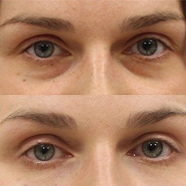 HIALUROPEN , HACIDO HIALURONICO ,ENTRECEJO Y NASOGENIANO,MALLORCA ESTETICA MOURE (2)