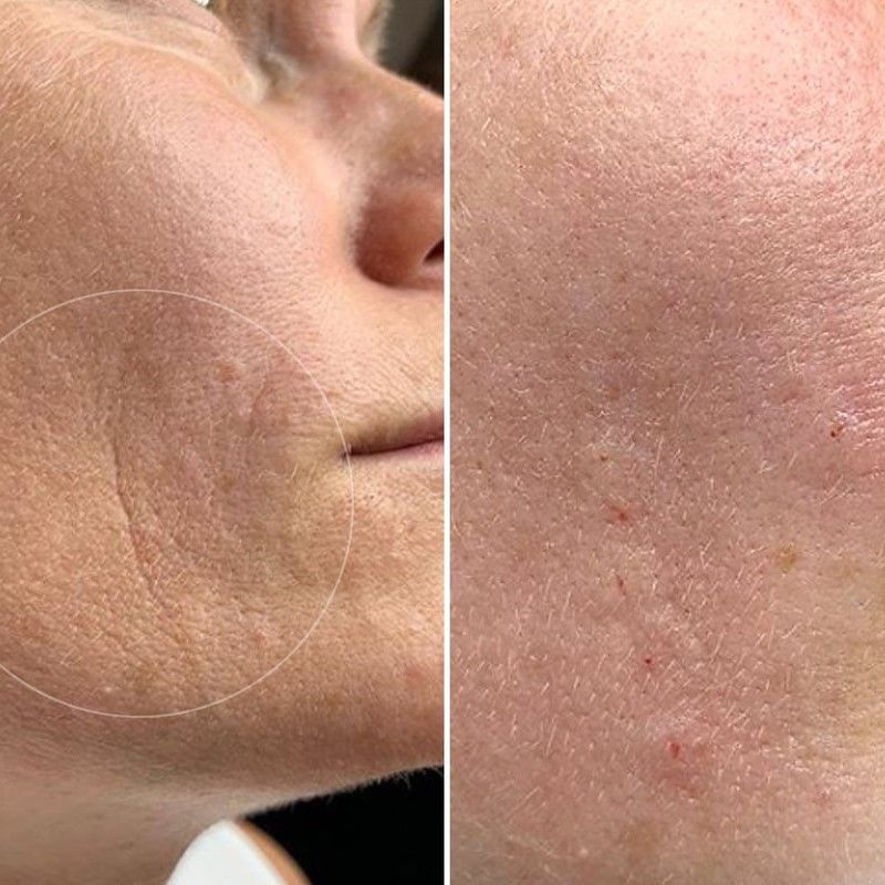 HIALUROPEN , HACIDO HIALURONICO ,ENTRECEJO Y NASOGENIANO,MALLORCA ESTETICA MOURE (3)